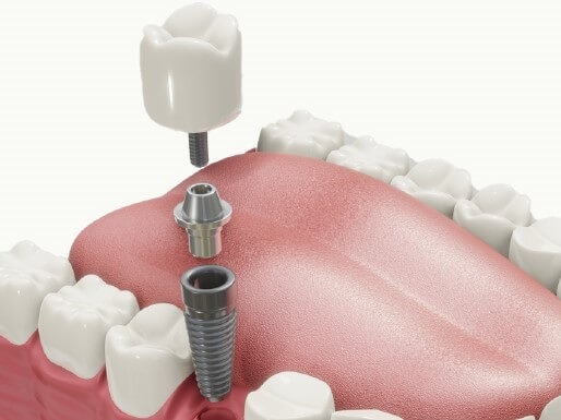 他の歯への影響