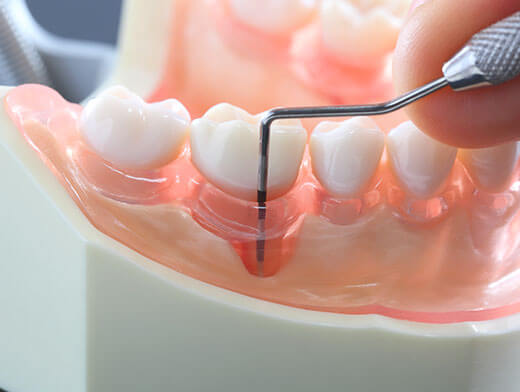 歯周病検査の模型