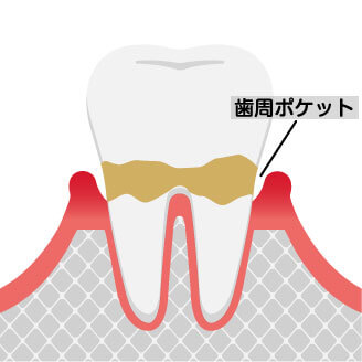 軽度の歯周病は歯周ポケットを作り出します