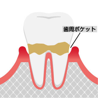 初期の歯周病は薄いピンクから赤くなります