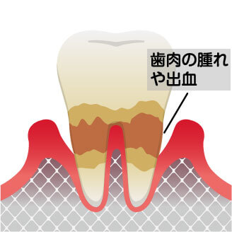 中度の歯周病は歯周ポケットの炎症がひどくなります