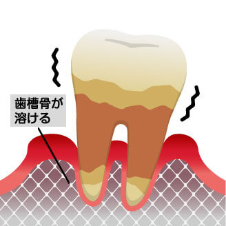 重度の歯周病は歯を支える骨がほぼ溶かされている状態です