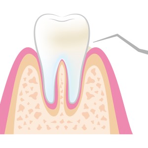 歯石除去