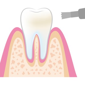歯面清掃