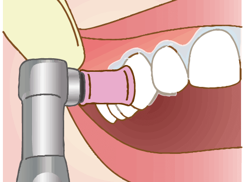 歯石除去