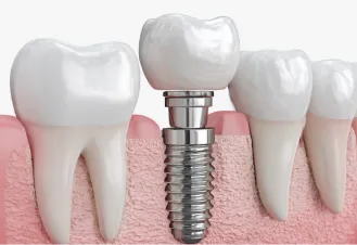 インプラント治療の構造を示す図。人工歯根があごの骨に固定され、上部にセラミックの人工歯が装着されているイメージ