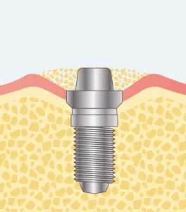 インプラント埋入と同時に行う骨造成ステップ01