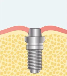 インプラント埋入と同時に行う骨造成ステップ02
