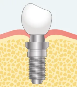 インプラント埋入と同時に行う骨造成ステップ03