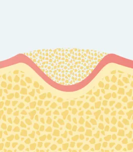 GBRを先に行う場合のステップ01イラスト