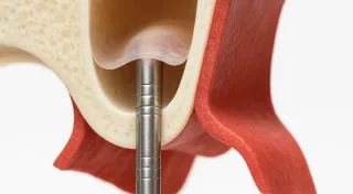 ソケットリフト