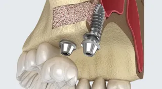 サイナスリフト